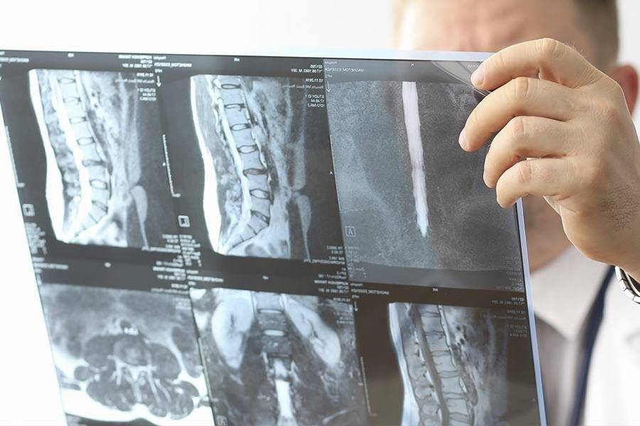 Centro de la Columna Vertebral tiene tratamiento de hernias discales