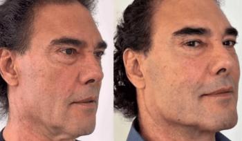 Así es el tratamiento estético que rejuveneció el rostro de Eduardo Yáñez